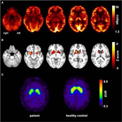 Chorea-Acanthocytosis Presenting as Autosomal Recessive Epilepsy in a Family With a Novel VPS13A Mutation